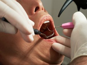 Tooth Infection